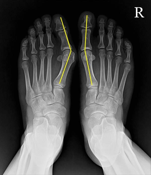 수술 전x-ray.jpg