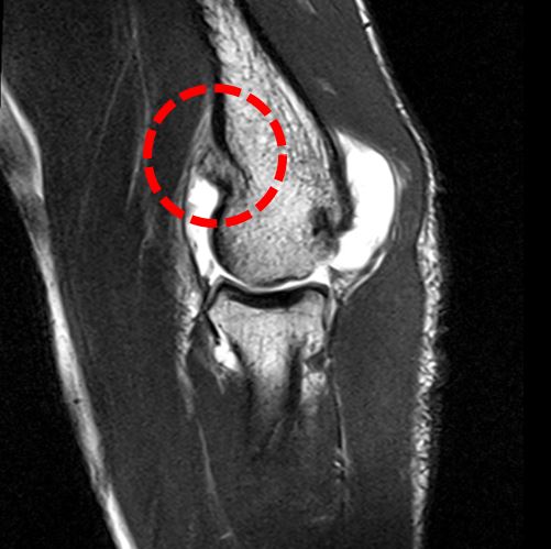 팔꿈치관절구축_MRA_1.jpg