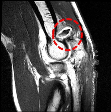 팔꿈치관절구축_MRA_2.jpg