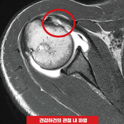 견갑하건-관절-내-파열.jpg