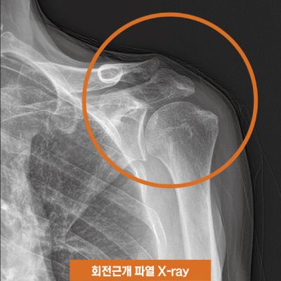 회전근개파열X-ray.jpg