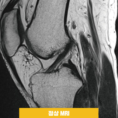 전방정상mri.jpg