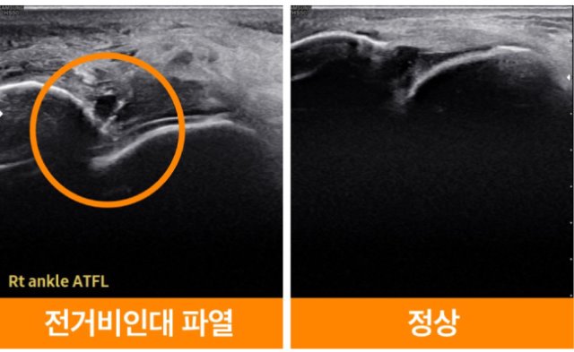 전거비인대파열.jpg