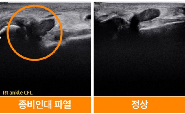 종비인대파열.jpg