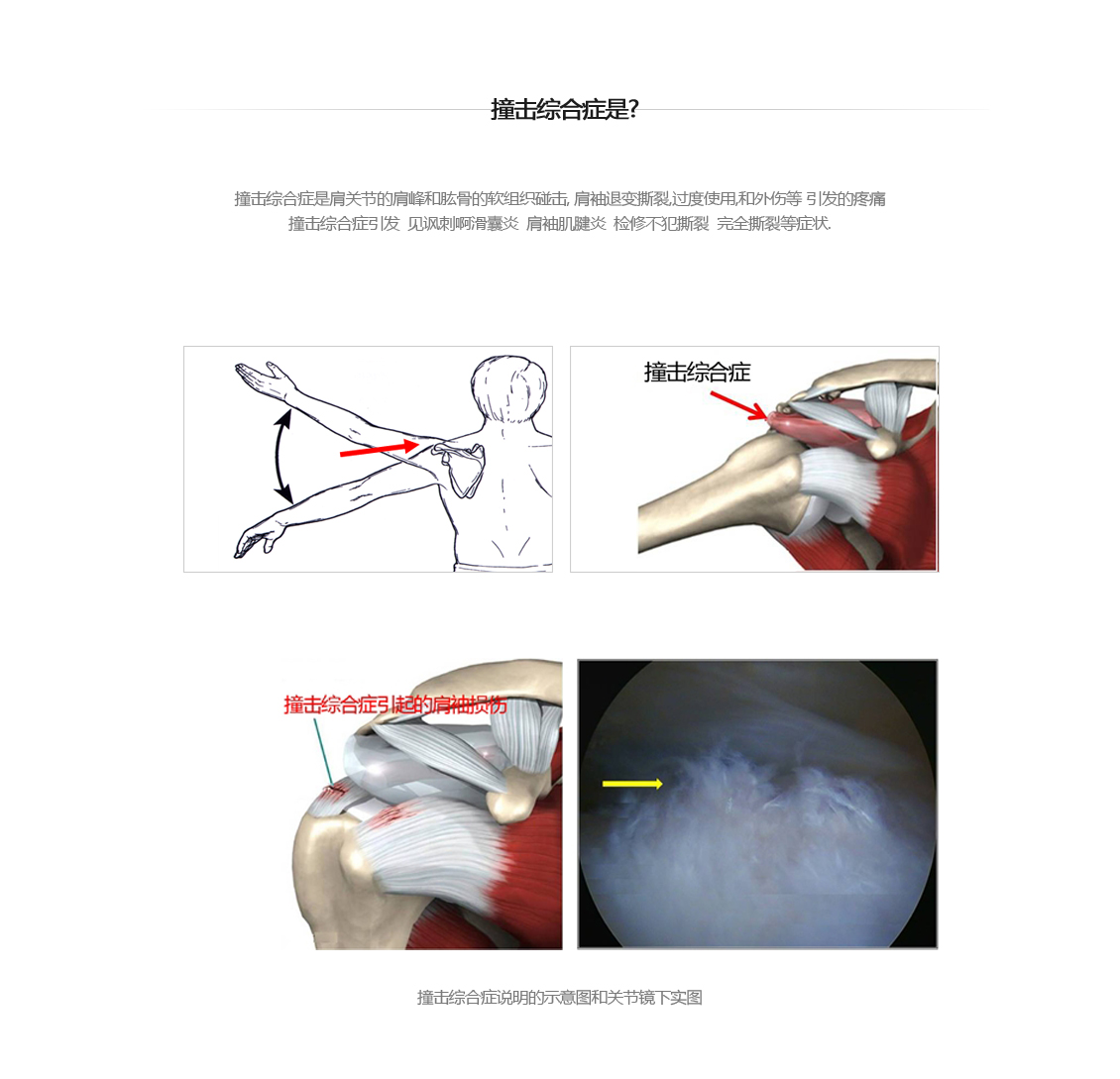 충돌증후군