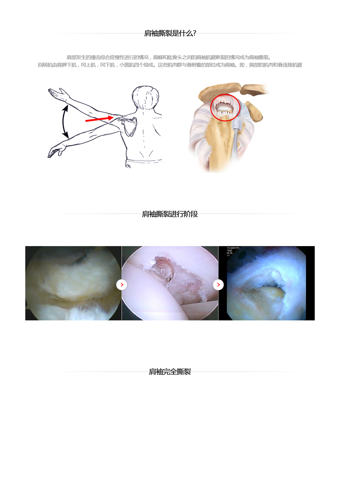 회전근개파열