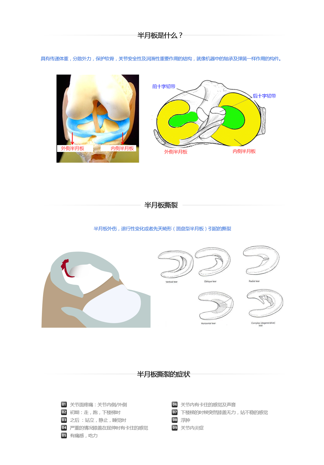 반월상연골파열