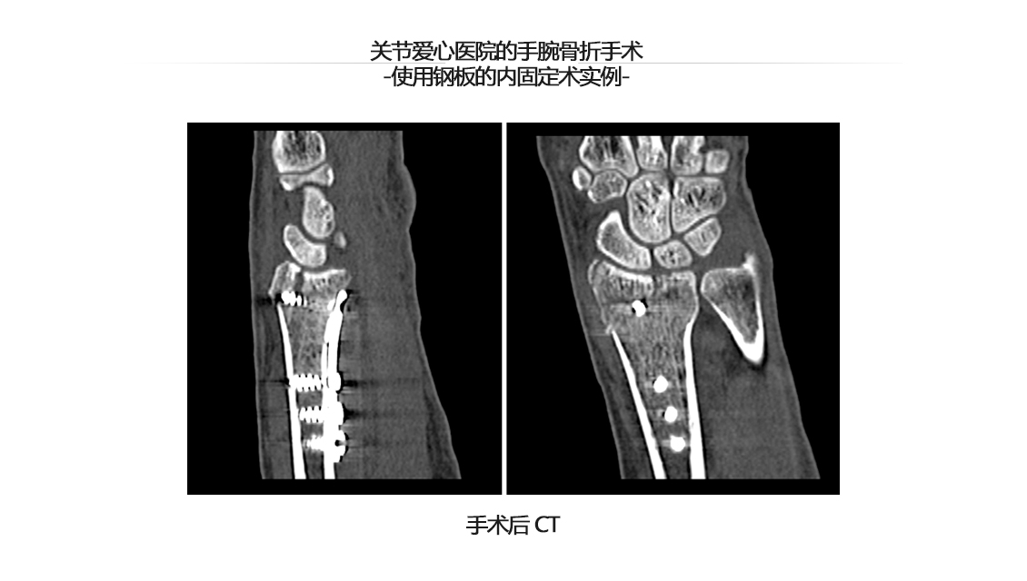 손목 관절 골절