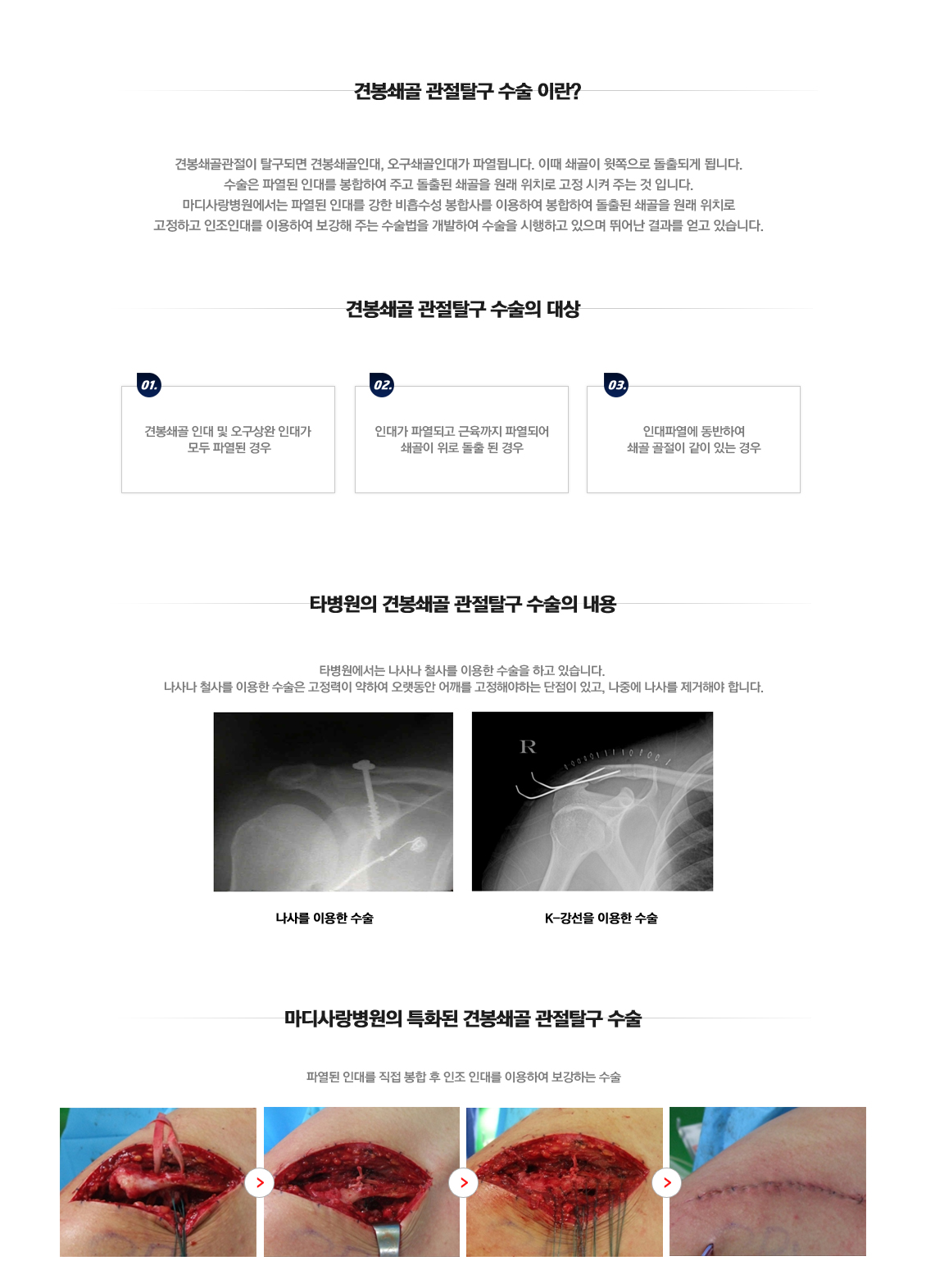 습관성 탈구