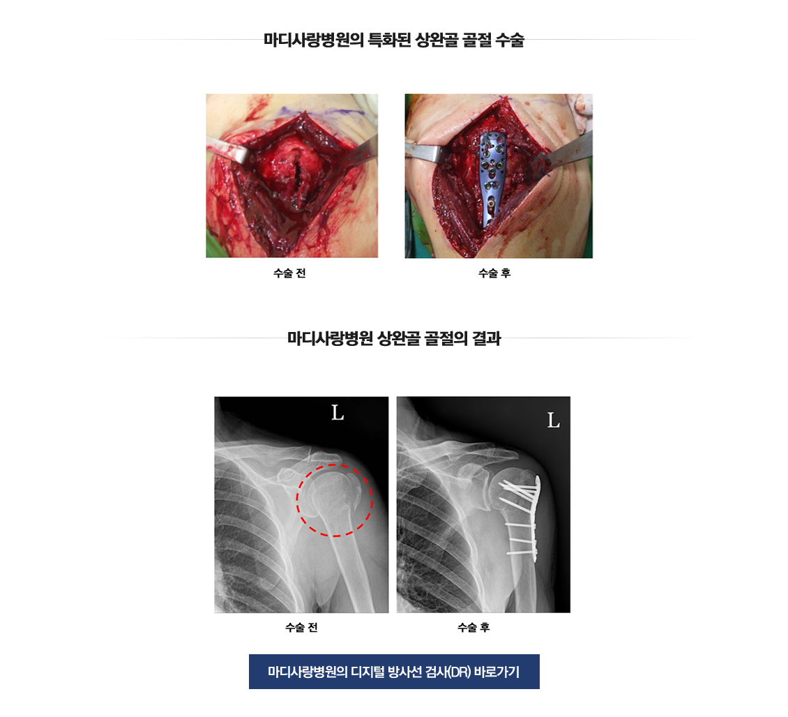 어깨 골절수술