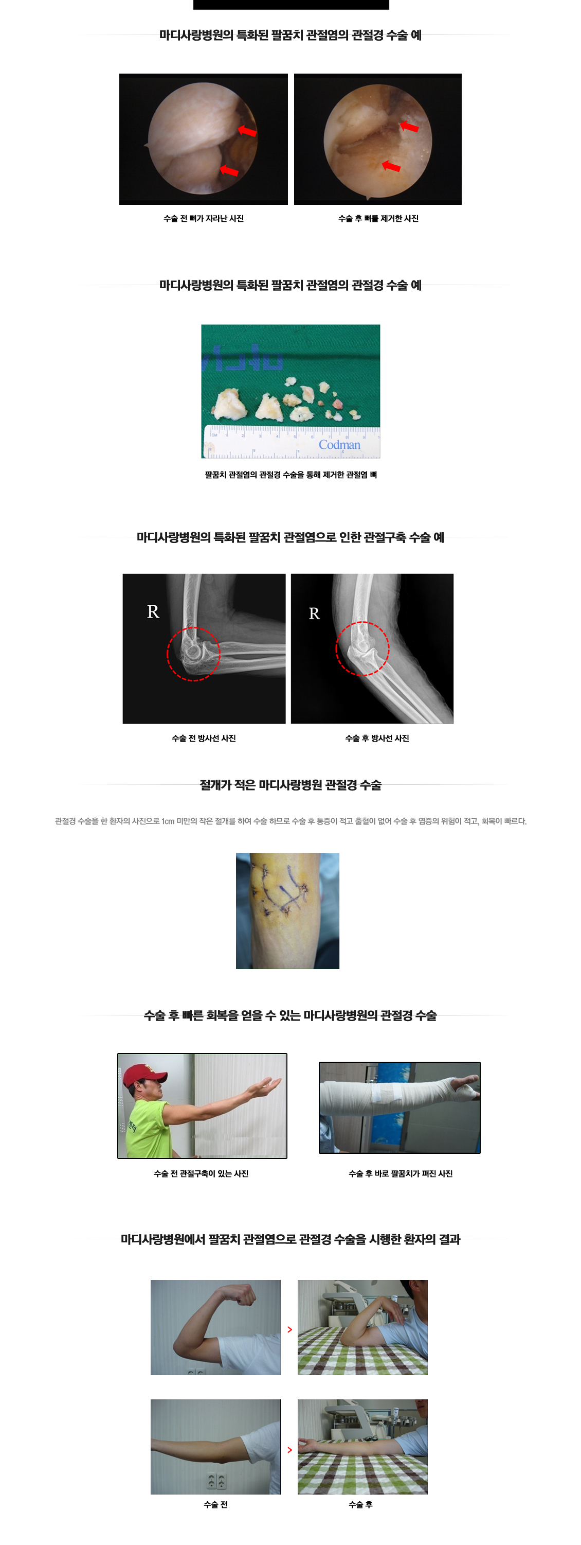 팔꿈치 관절염