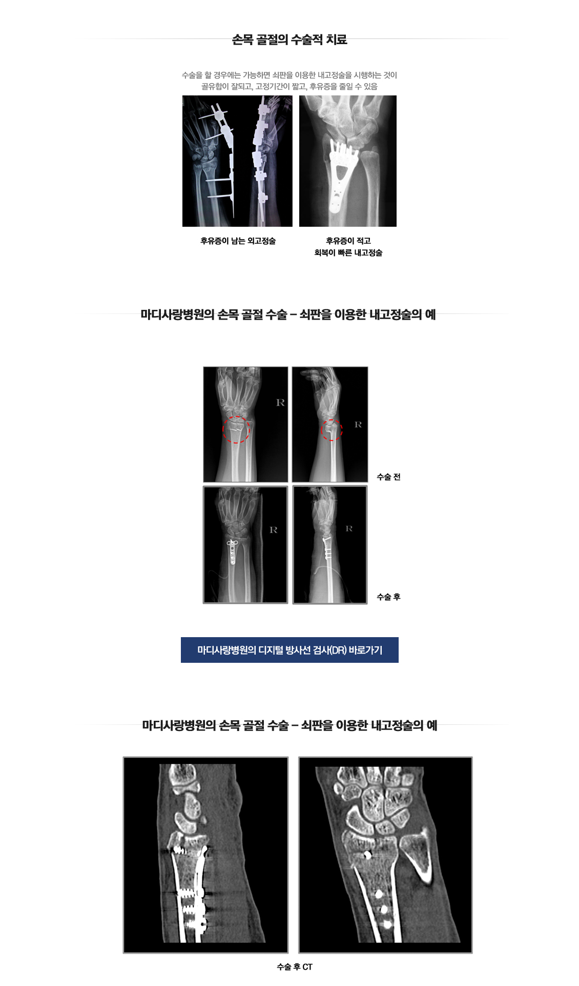 손목 골절수술