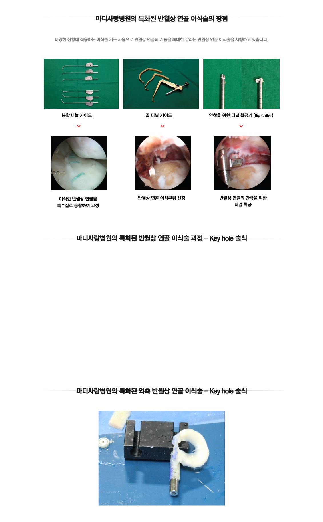 반월상연골 이식술