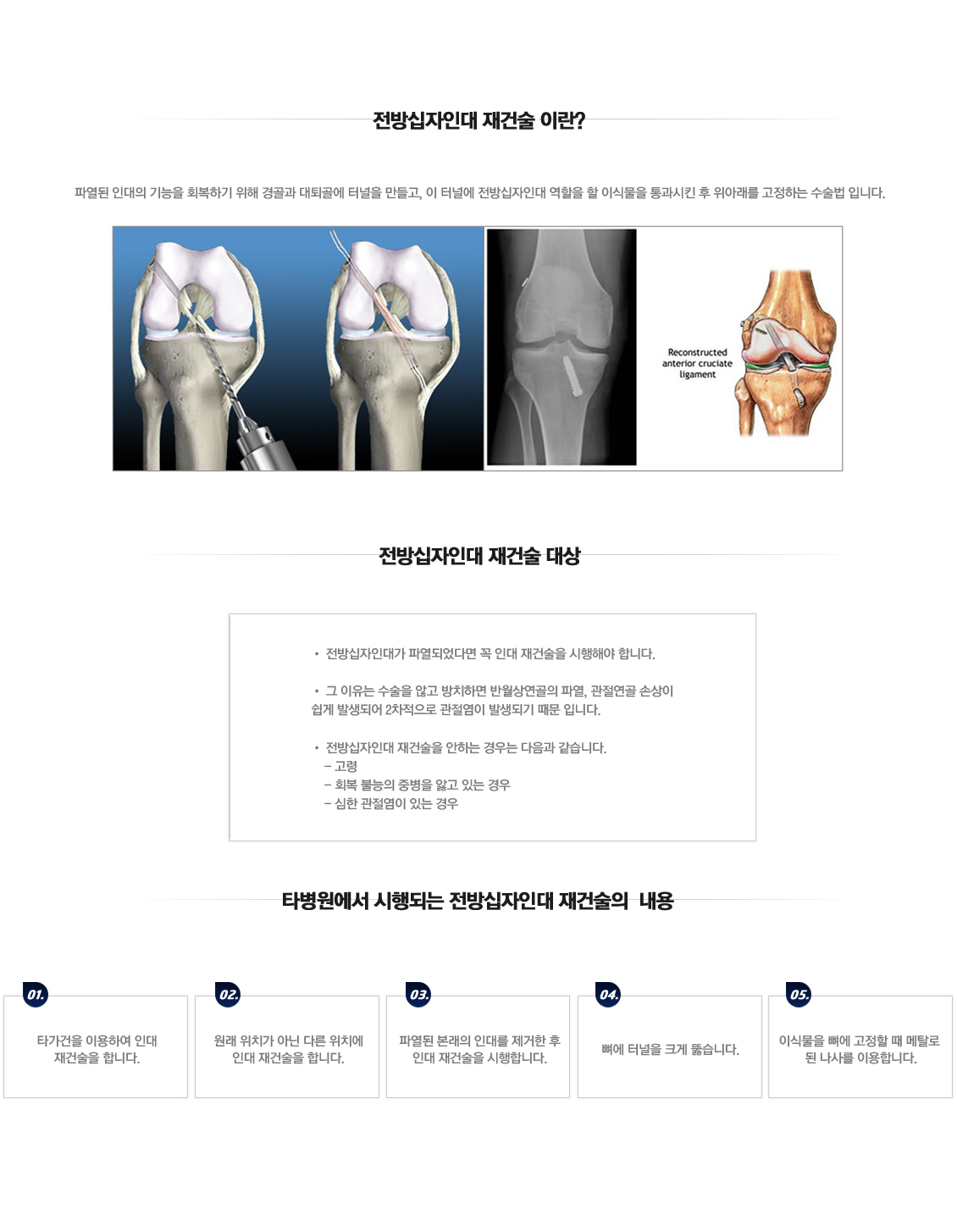 전방십자인대 재건술