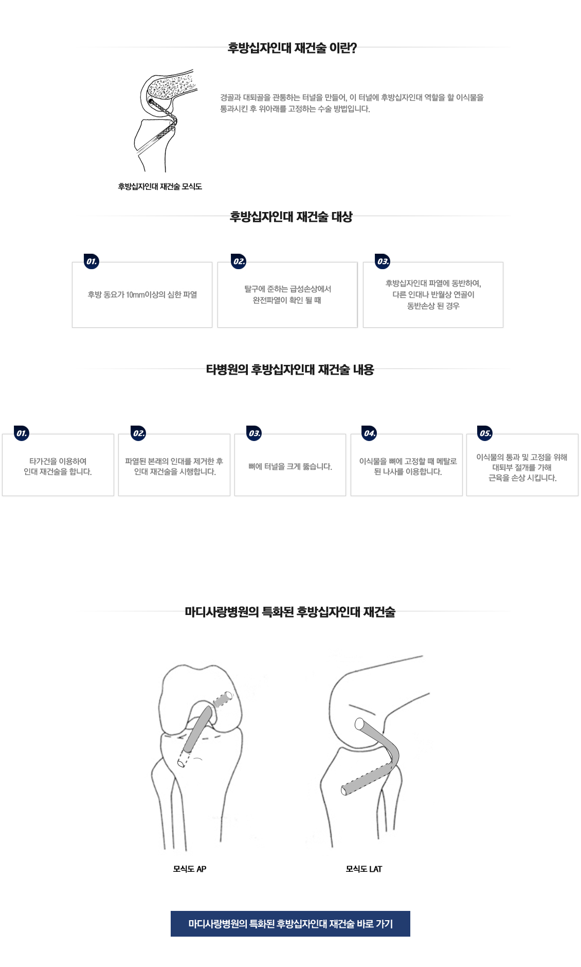 후방십자인대 재건술