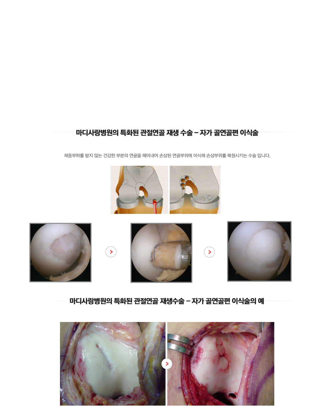 관절연골 재생 수술