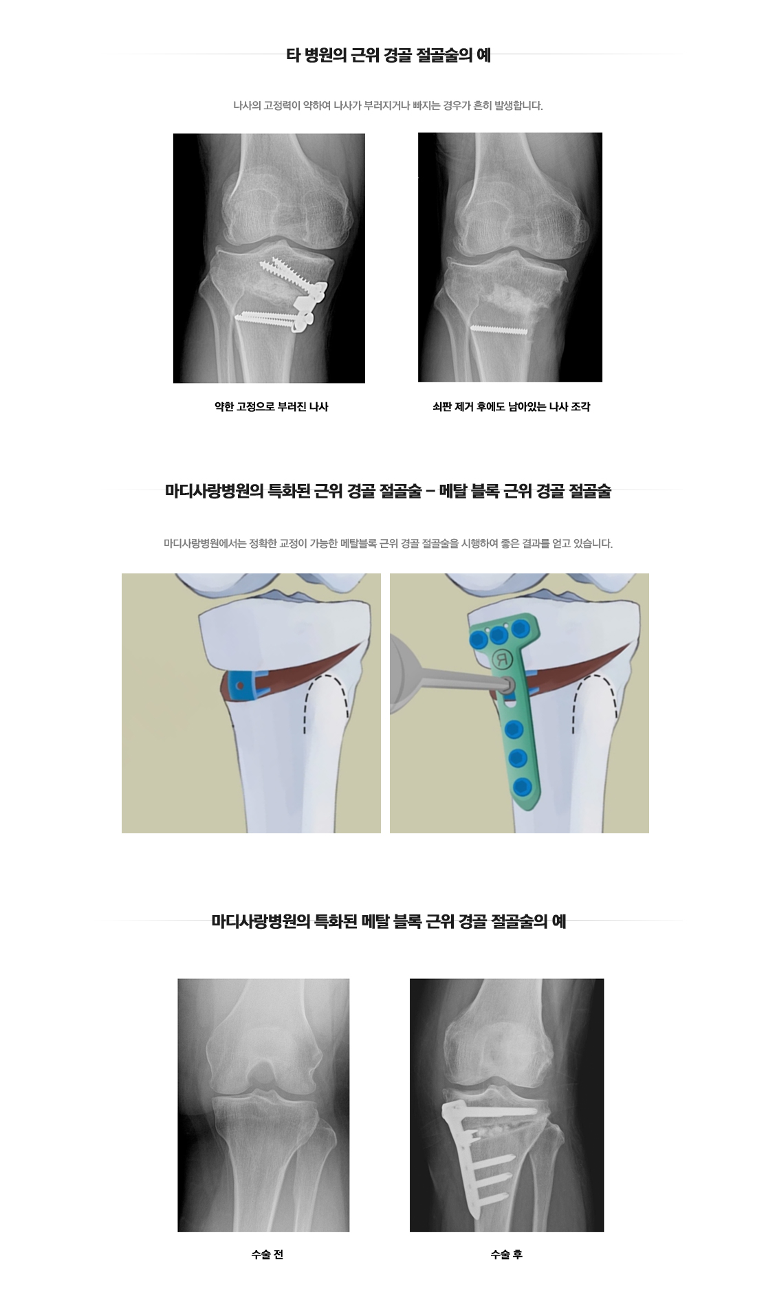 근위경골 절골술