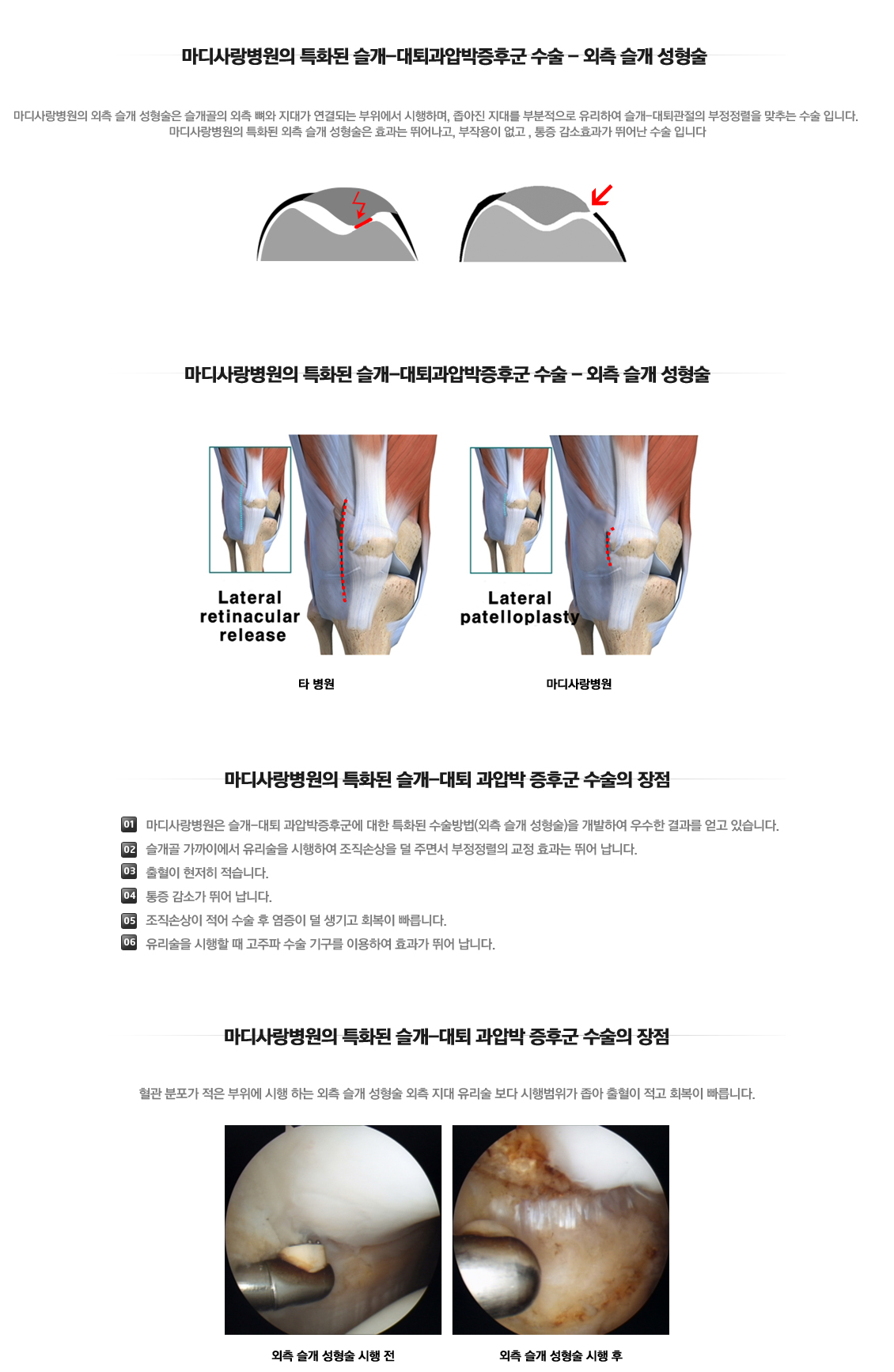 슬개대퇴관절 과압박 증후군