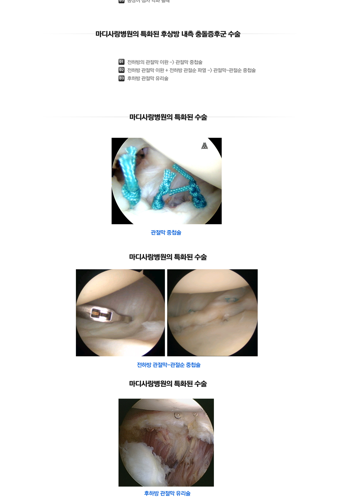 후상방내측Impingement syndrome 