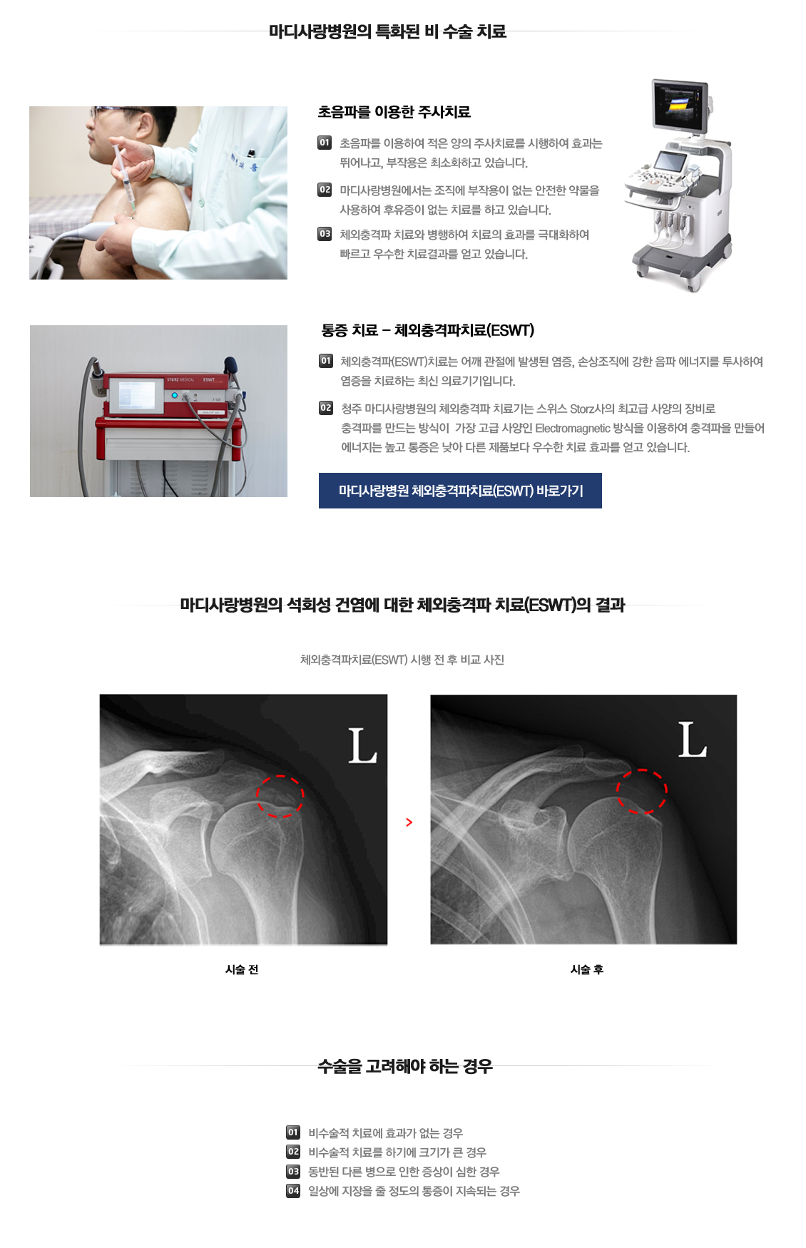 Calcific tendinitis