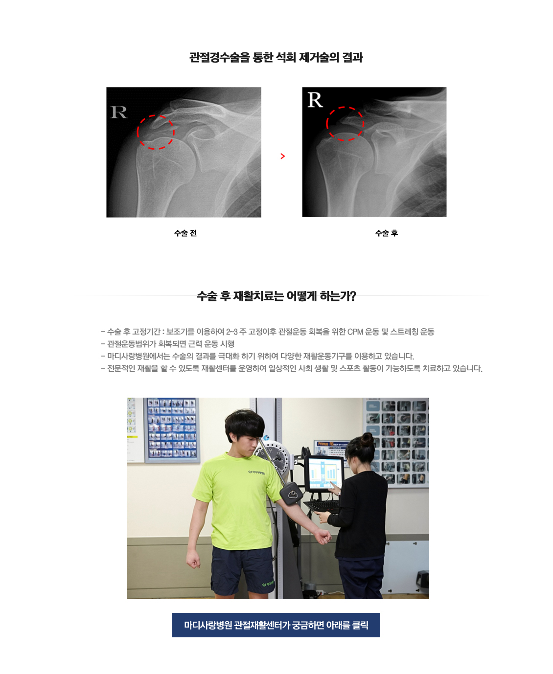 Calcific tendinitis