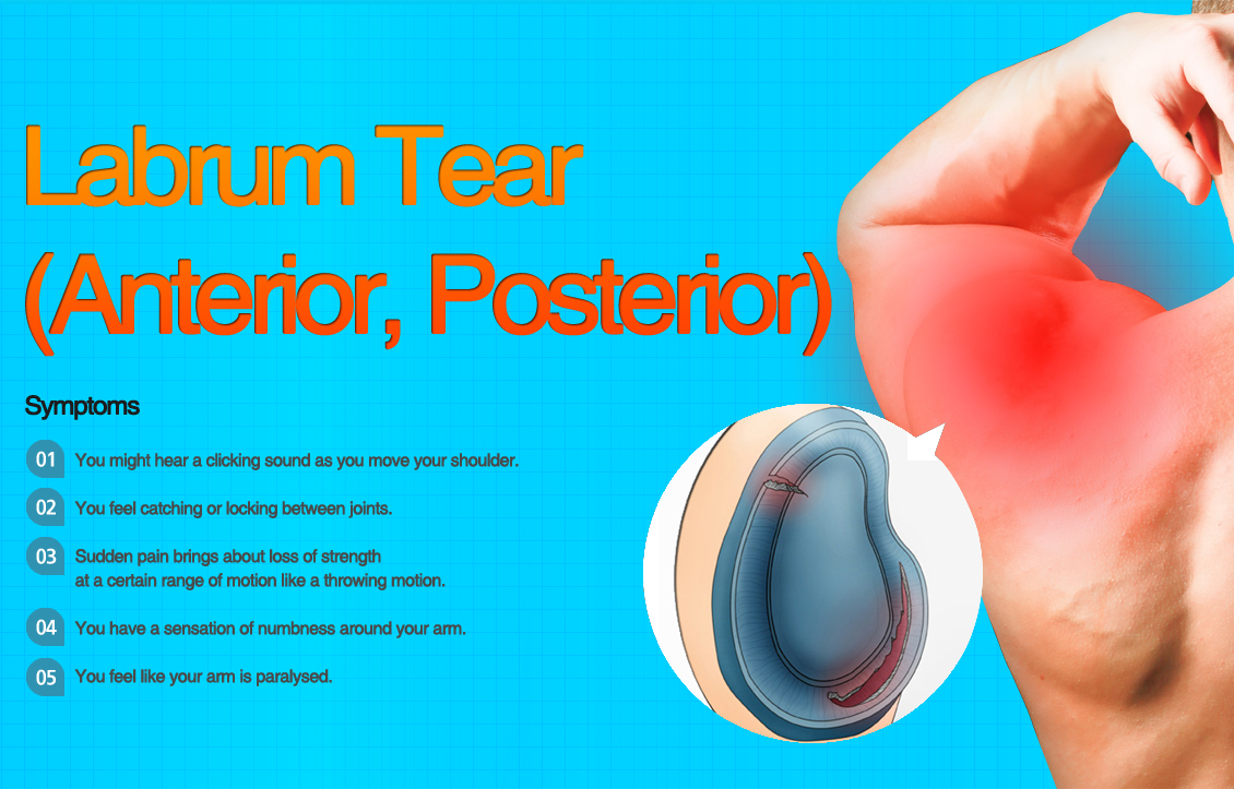 Labrum tear