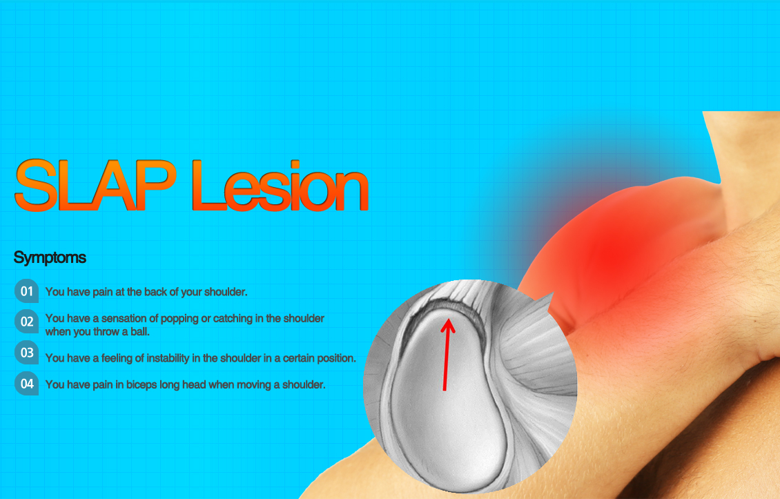 SLAP lesion