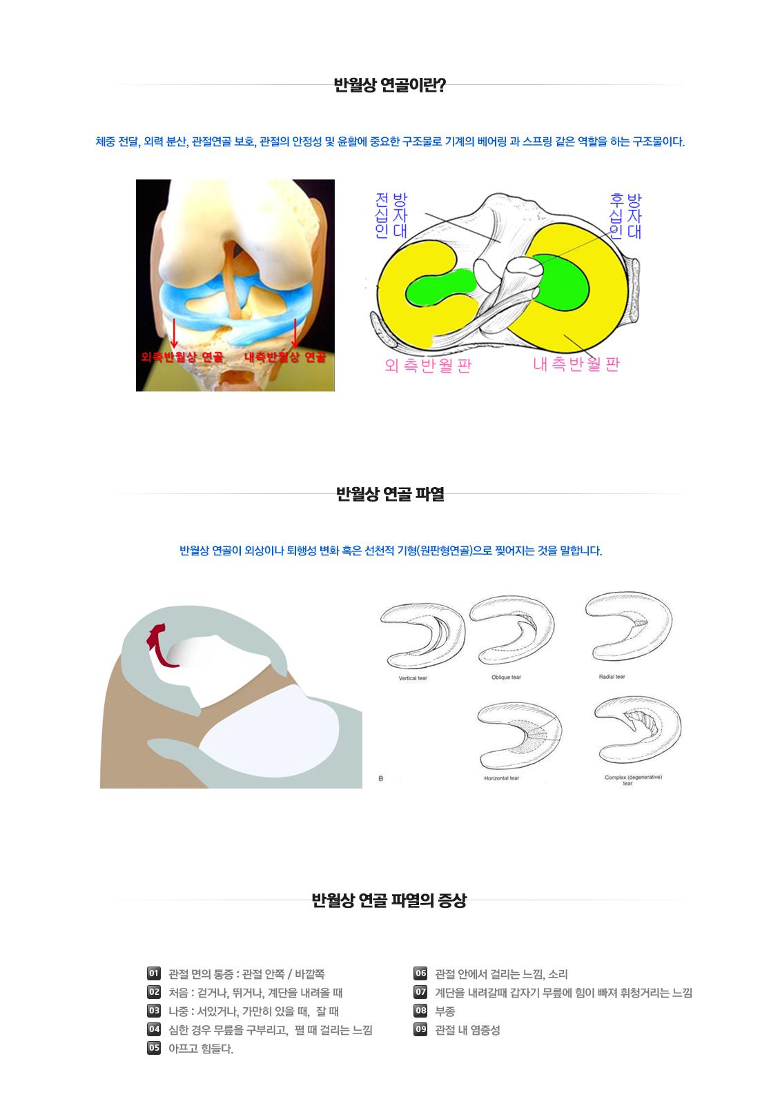 Meniscus Tears