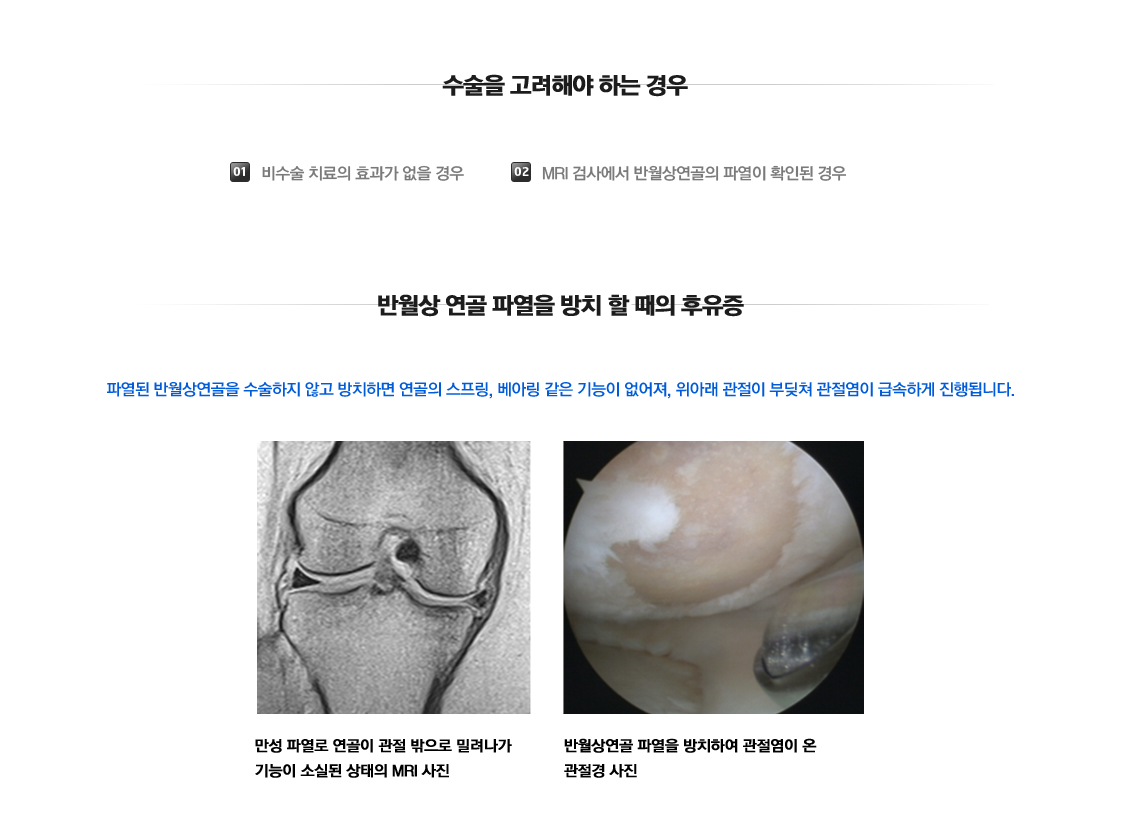 Meniscus Tears