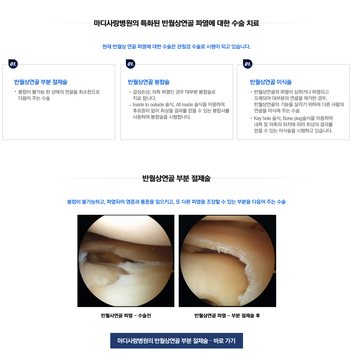 Meniscus Tears