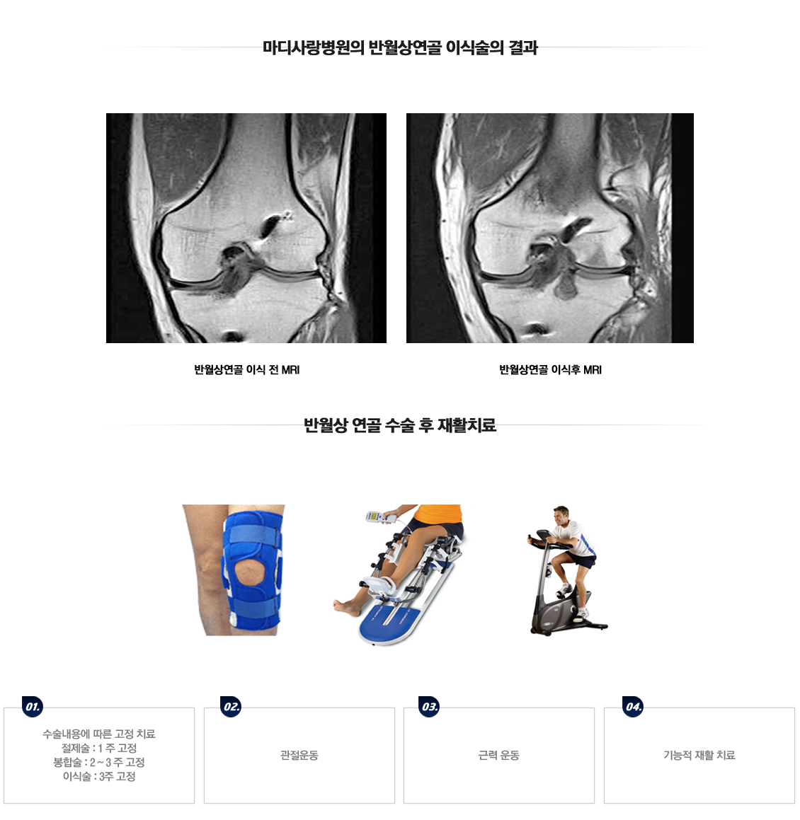 Meniscus Tears