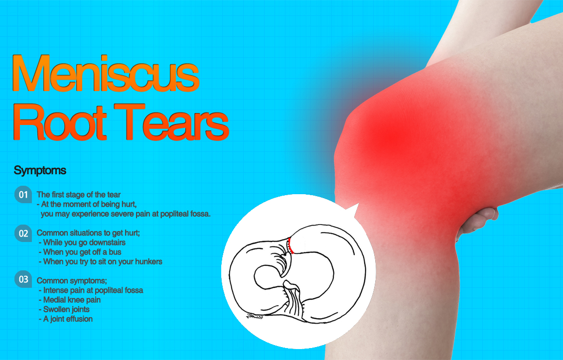 Meniscus Root Tears