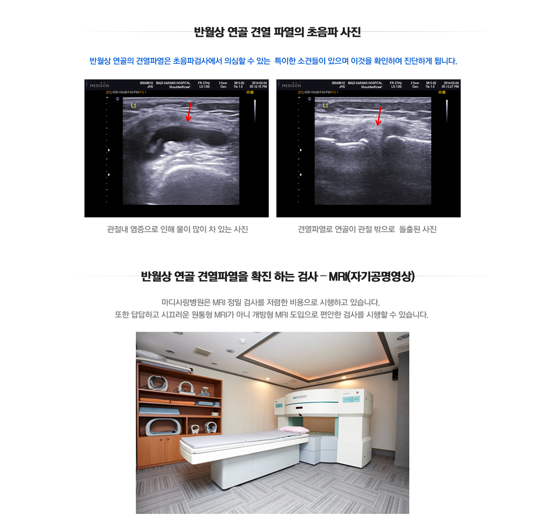 Meniscus Root Tears