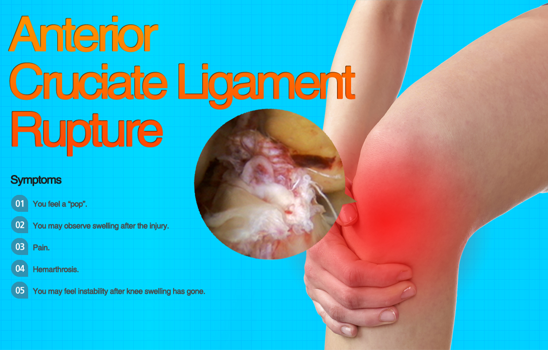 ACL Rupture