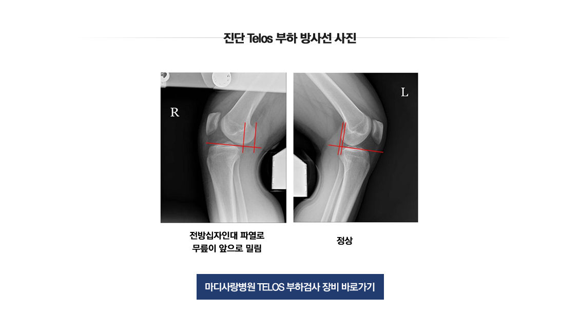 ACL Rupture