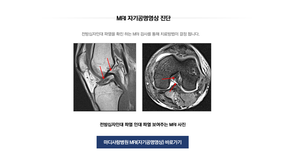 ACL Rupture