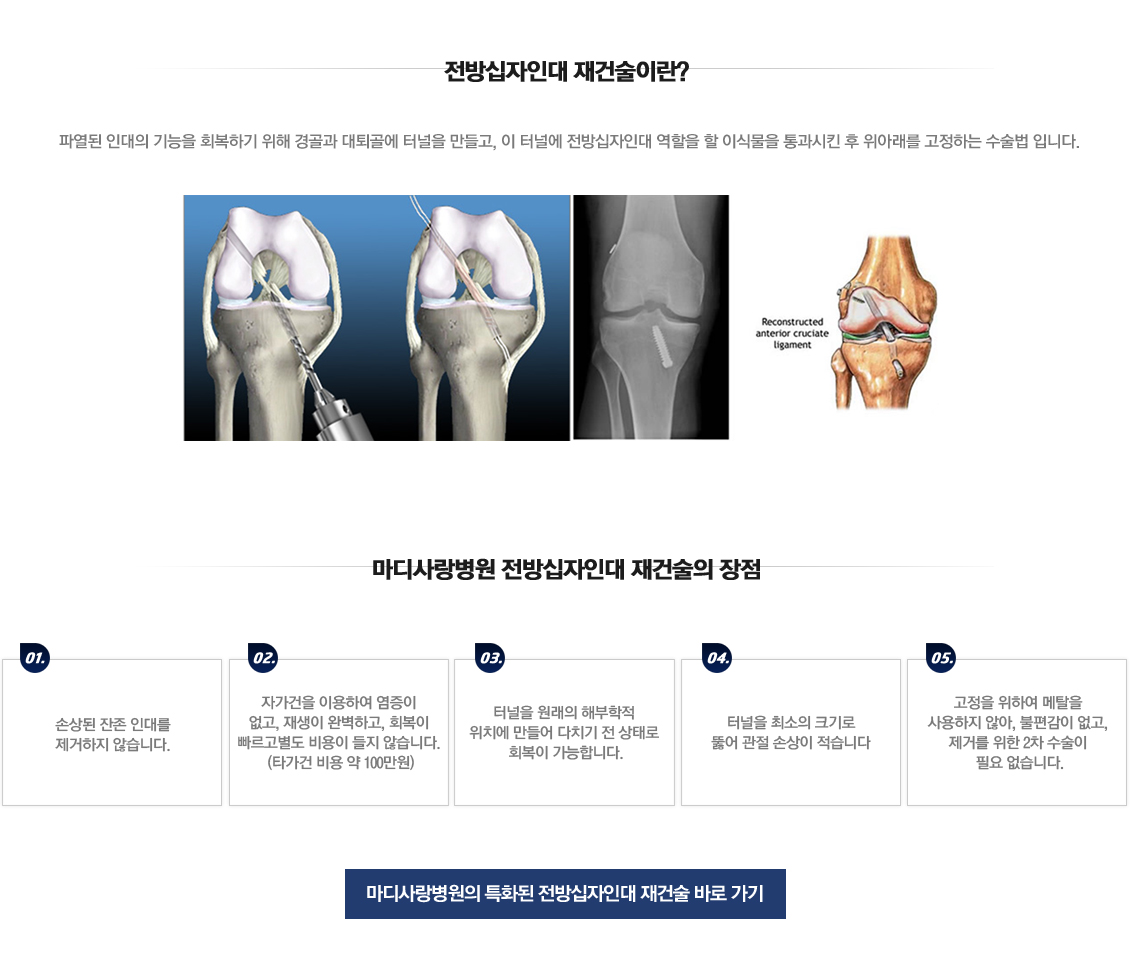 ACL Rupture