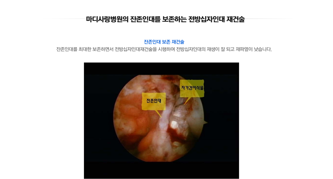 ACL Rupture