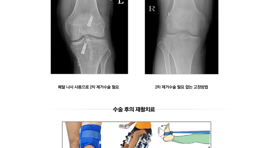 ACL Rupture