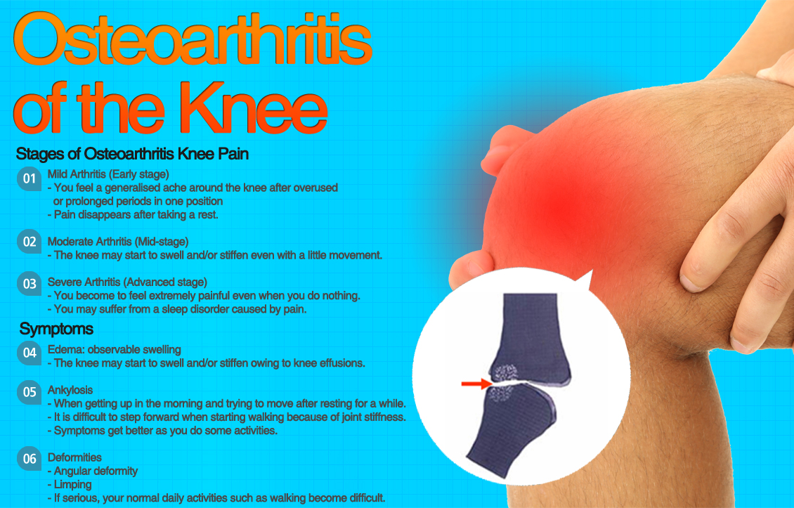 ACL Rupture