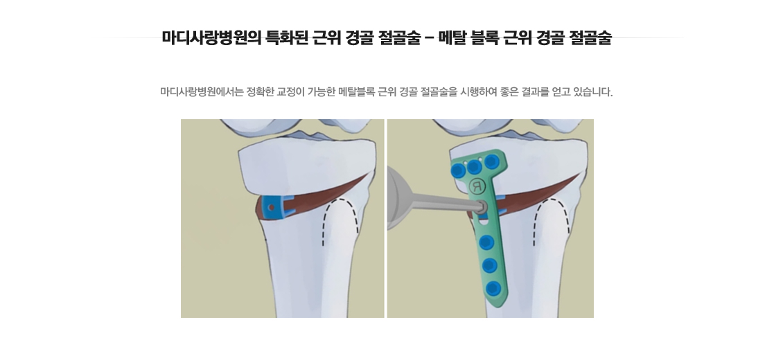 Osteoarthritis