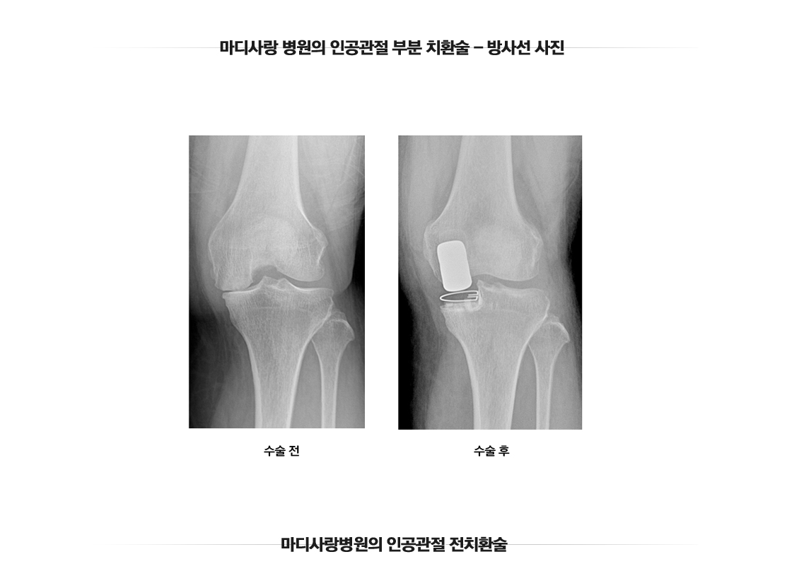 Osteoarthritis