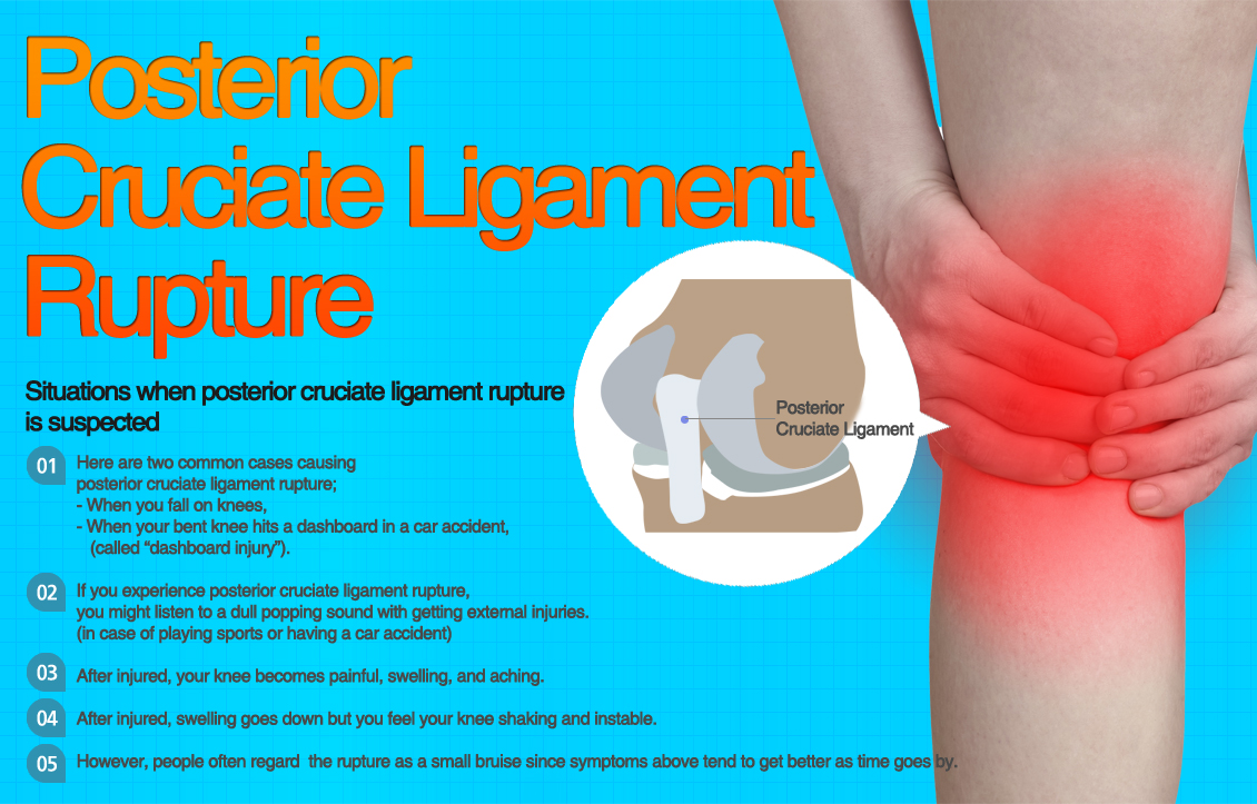 ACL Rupture