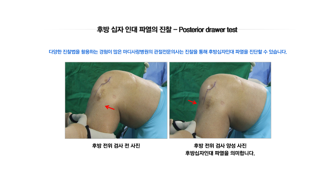 PCL Rupture