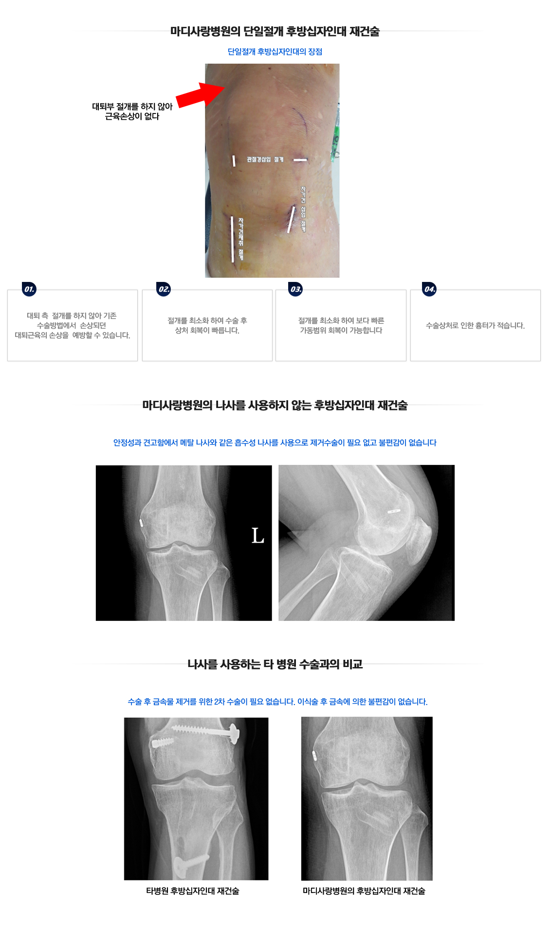 PCL Rupture