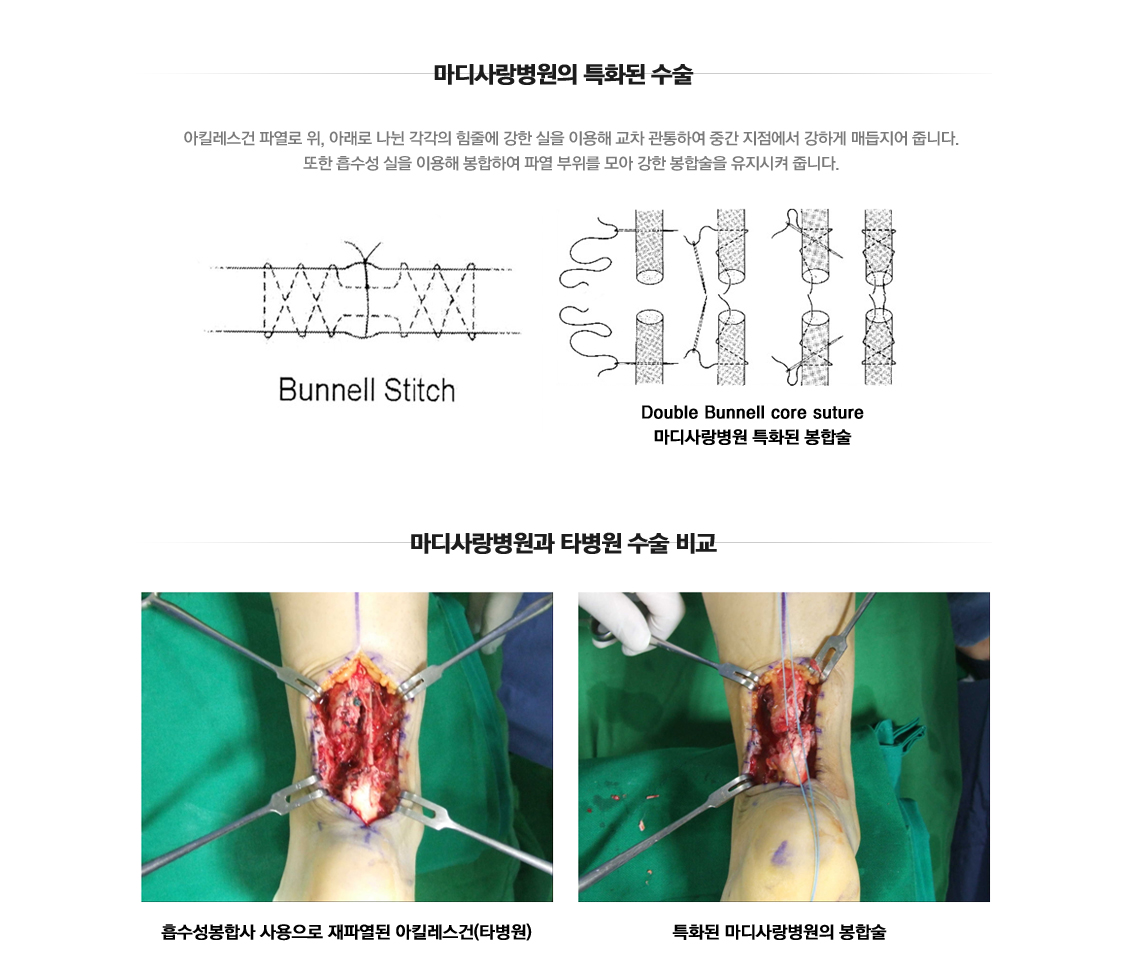 Achilles Tendon Injury