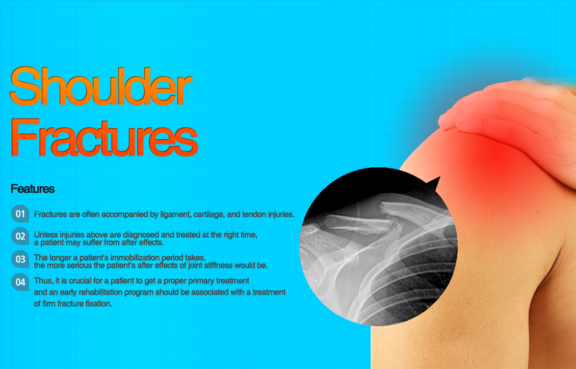 Shoulder Fracture