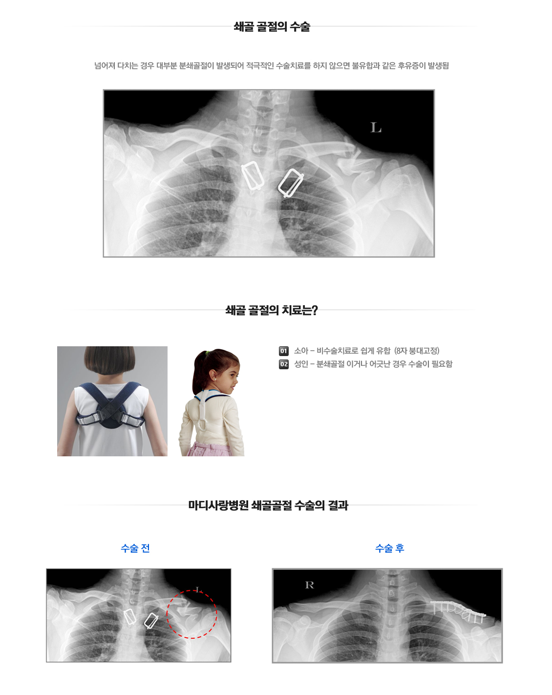 Shoulder Fracture