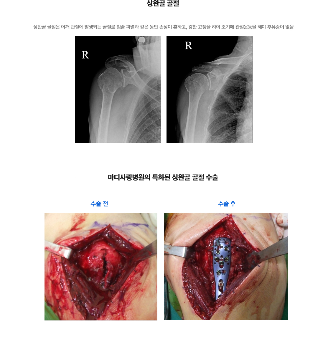 Shoulder Fracture