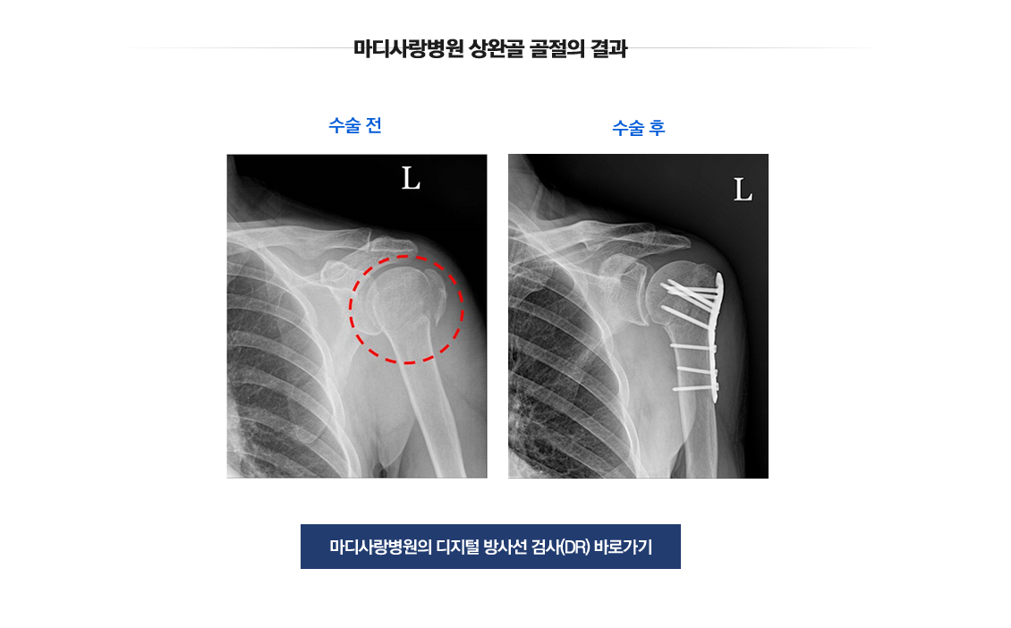 Shoulder Fracture